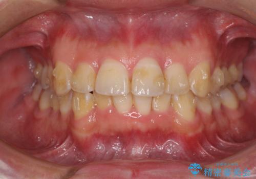 ディープバイトと叢生を解消 インビザライン矯正の治療中