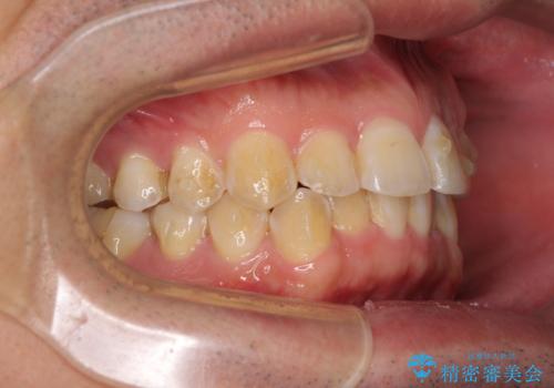 ディープバイトと叢生を解消 インビザライン矯正の治療中