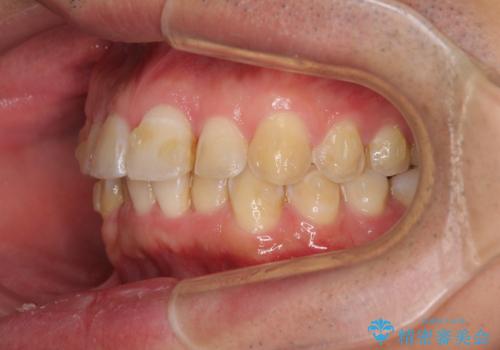 ディープバイトと叢生を解消 インビザライン矯正の治療中