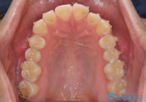 ディープバイトと叢生を解消 インビザライン矯正の治療中