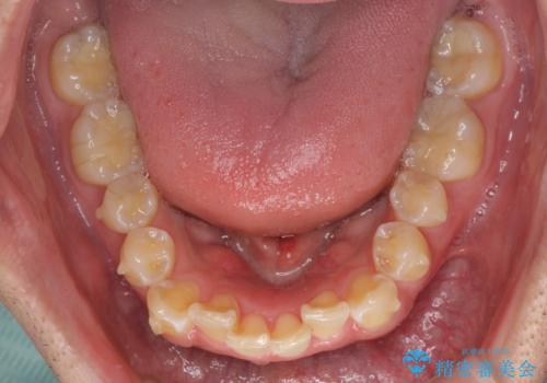 ディープバイトと叢生を解消 インビザライン矯正の治療中