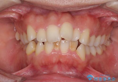 口元をスッキリと　ワイヤー装置による抜歯矯正の症例 治療前