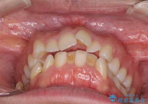 口元をスッキリと　ワイヤー装置による抜歯矯正の治療前