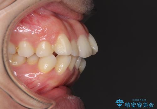 口元をスッキリと　ワイヤー装置による抜歯矯正の治療前