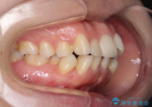 口元をスッキリと ワイヤー装置による抜歯矯正の治療前