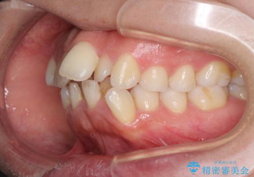 口元をスッキリと ワイヤー装置による抜歯矯正の治療前