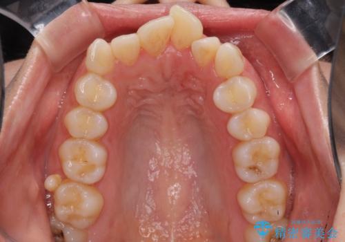 口元をスッキリと ワイヤー装置による抜歯矯正の治療前