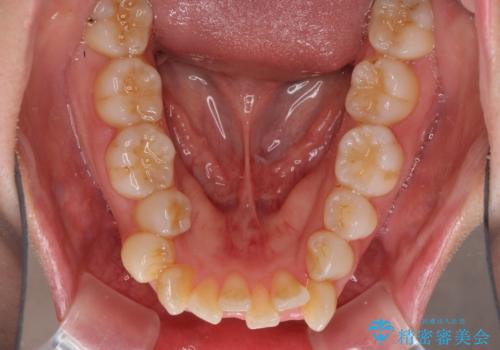 口元をスッキリと ワイヤー装置による抜歯矯正の治療前