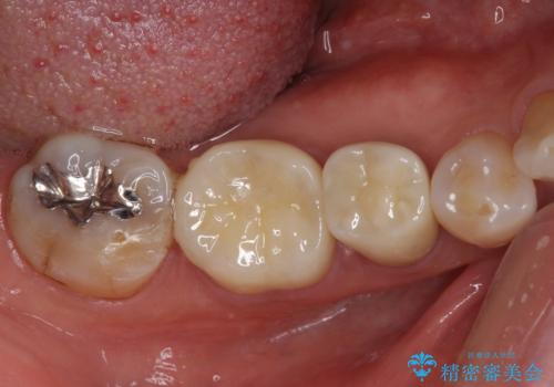 欠けてしまった奥歯 セラミッククラウンによる補綴治療の治療後
