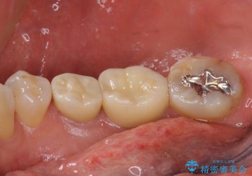 欠けてしまった奥歯 セラミッククラウンによる補綴治療の治療後