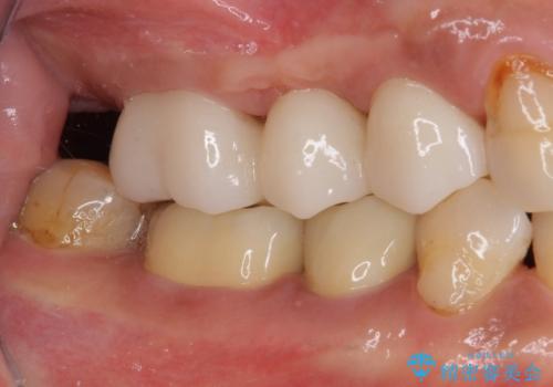 欠けてしまった奥歯 セラミッククラウンによる補綴治療の治療後