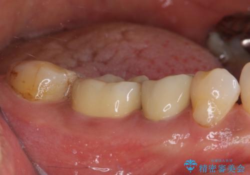 欠けてしまった奥歯 セラミッククラウンによる補綴治療の治療後