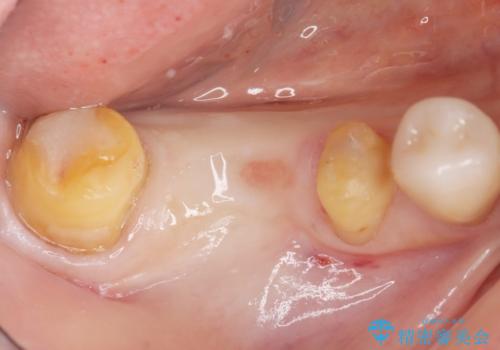 奥歯 抜歯してブリッジに 50代女性の治療中