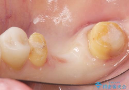 奥歯 抜歯してブリッジに 50代女性の治療中