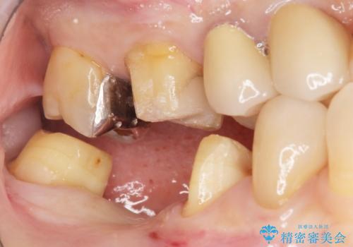 奥歯 抜歯してブリッジに 50代女性の治療中