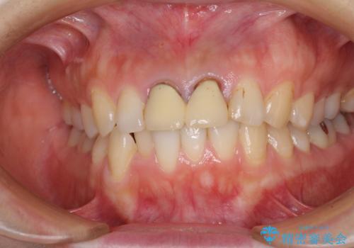 変色した前歯のクラウン　オールセラミッククラウンにより審美歯科治療の治療前