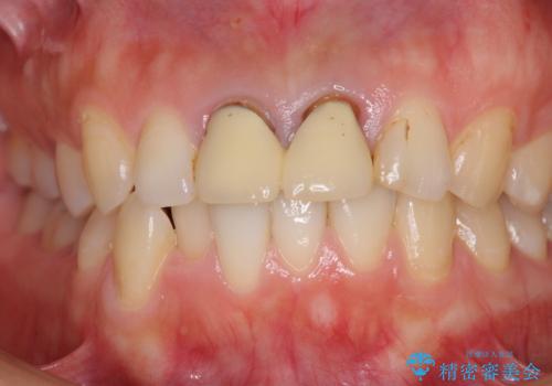 変色した前歯のクラウン オールセラミッククラウンにより審美歯科治療の治療前