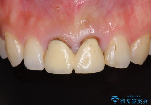 変色した前歯のクラウン　オールセラミッククラウンにより審美歯科治療の症例 治療前