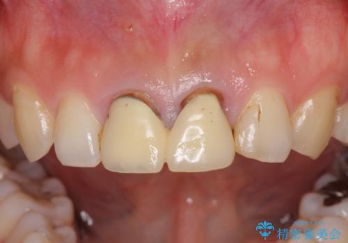 変色した前歯のクラウン　オールセラミッククラウンにより審美歯科治療の治療前