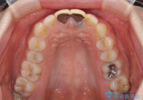 変色した前歯のクラウン オールセラミッククラウンにより審美歯科治療の治療前