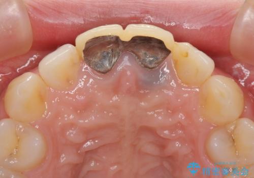 変色した前歯のクラウン オールセラミッククラウンにより審美歯科治療の治療前