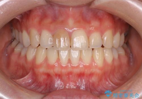 前歯1本だけ色が違う:他の歯となじむ被せ物で自然な仕上がりにの治療前