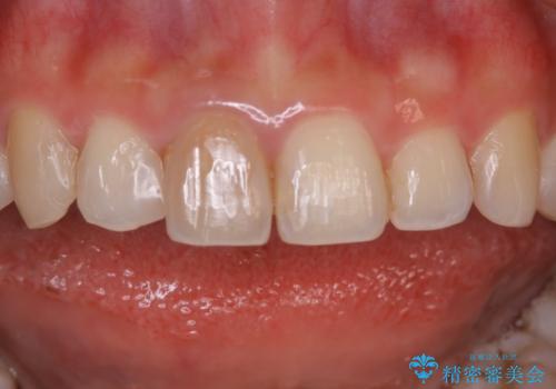 前歯1本だけ色が違う:他の歯となじむ被せ物で自然な仕上がりにの治療前