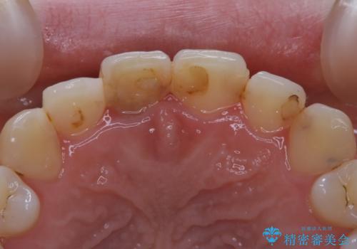 前歯1本だけ色が違う:他の歯となじむ被せ物で自然な仕上がりにの治療前