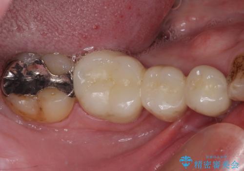 穴を開けられ抜歯となった奥歯　セラミックブリッジによる補綴治療の症例 治療後