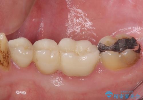 穴を開けられ抜歯となった奥歯 セラミックブリッジによる補綴治療の治療後