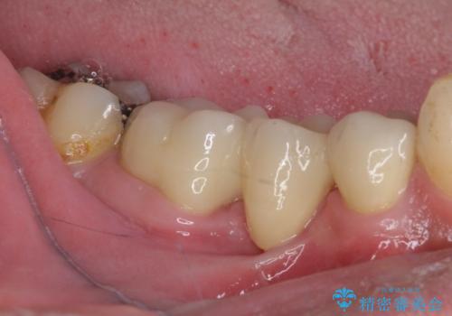 穴を開けられ抜歯となった奥歯 セラミックブリッジによる補綴治療の治療後