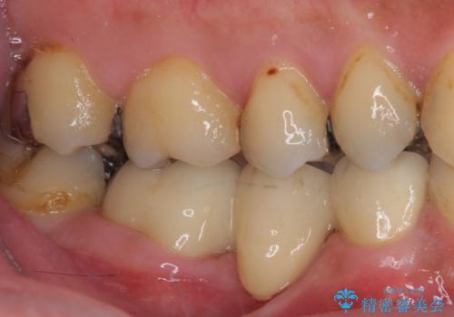 穴を開けられ抜歯となった奥歯 セラミックブリッジによる補綴治療の治療後