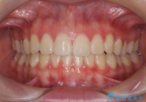 前歯のデコボコを改善　インビザライン矯正
