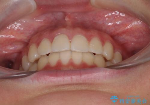 前歯のデコボコを改善 インビザライン矯正の治療後