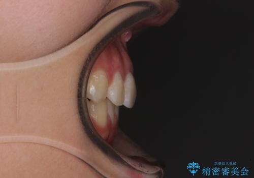 前歯のデコボコを改善 インビザライン矯正の治療後