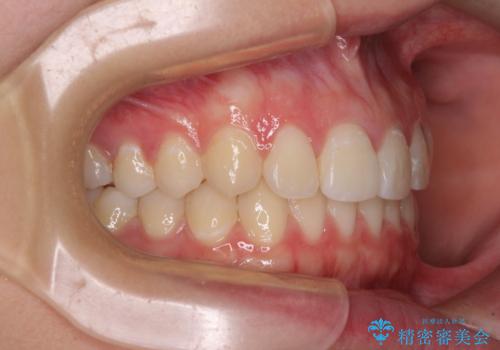 前歯のデコボコを改善　インビザライン矯正の治療後