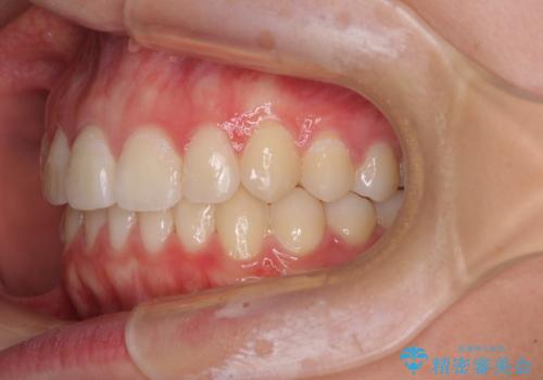 前歯のデコボコを改善　インビザライン矯正の治療後