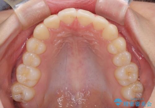 前歯のデコボコを改善 インビザライン矯正の治療後