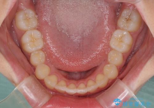 前歯のデコボコを改善 インビザライン矯正の治療後