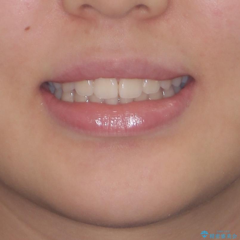 前歯のデコボコを改善　インビザライン矯正の治療後（顔貌）