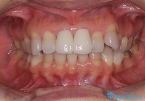 変色した前歯 オールセラミッククラウンにより審美歯科治療の治療後