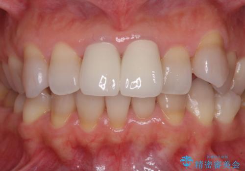 変色した前歯 オールセラミッククラウンにより審美歯科治療の治療後