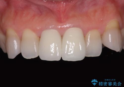 変色した前歯 オールセラミッククラウンにより審美歯科治療の症例 治療後