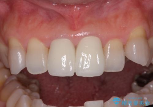 変色した前歯 オールセラミッククラウンにより審美歯科治療の治療後