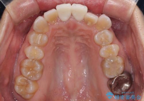 変色した前歯 オールセラミッククラウンにより審美歯科治療の治療後