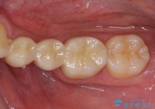 外れてしまった銀歯の詰め物 オールセラミックブリッジにて審美補綴の症例 治療後