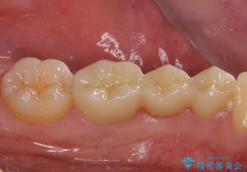 外れてしまった銀歯の詰め物 オールセラミックブリッジにて審美補綴の治療後