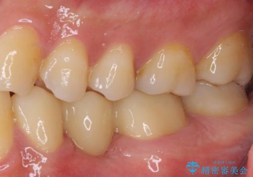 外れてしまった銀歯の詰め物 オールセラミックブリッジにて審美補綴の治療後