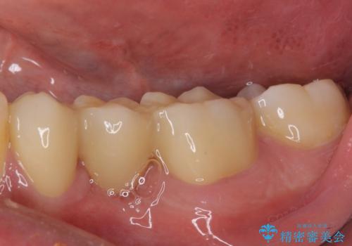 外れてしまった銀歯の詰め物 オールセラミックブリッジにて審美補綴の治療後
