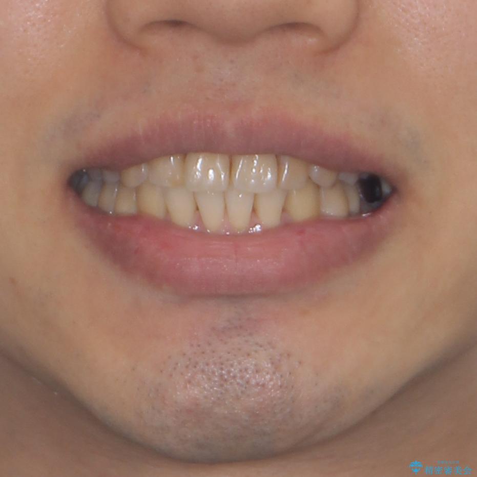 前歯のデコボコと下顎の八重歯　インビザラインによる矯正治療の治療後（顔貌）